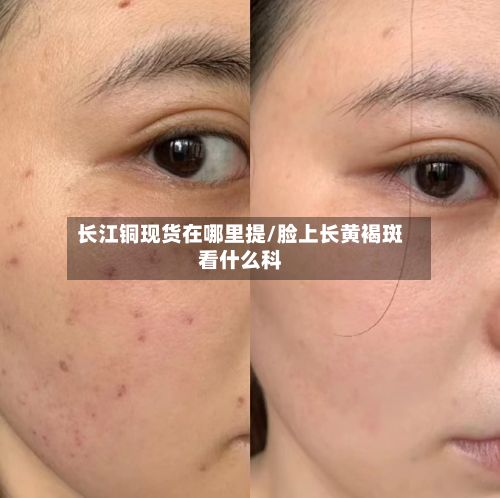 长江铜现货在哪里提/脸上长黄褐斑看什么科