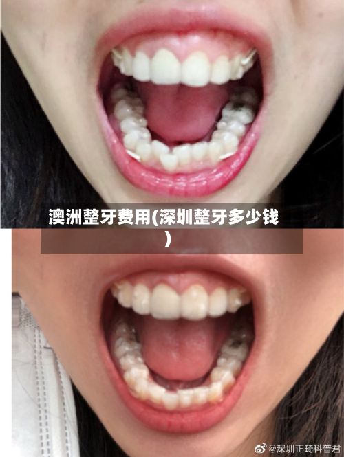 澳洲整牙费用(深圳整牙多少钱)